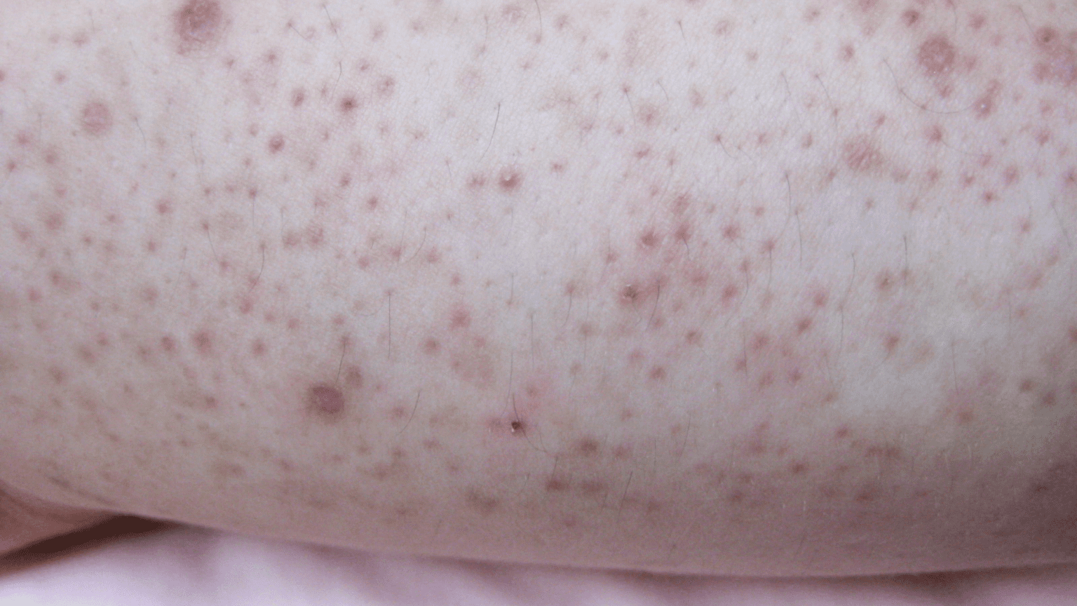 What is keratosis pilaris in children and how can you treat it